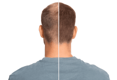 Hair Transplantation