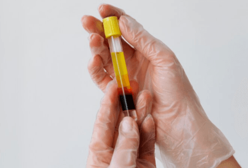 PRP Therapy